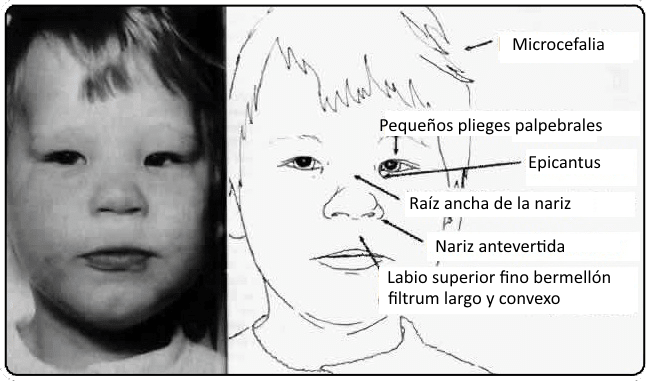 Sintomas afectados Depakine - Ácido Valproico